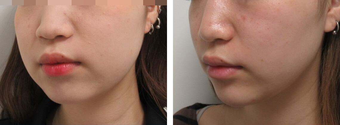 TAC式 ツヤ肌コラーゲンリフト®/バッカルファット除去の症例写真 施術前後 バッカルファット除去とリフトアップ1ヵ月