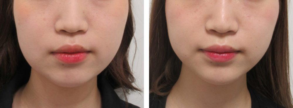 TAC式 ツヤ肌コラーゲンリフト®/バッカルファット除去の症例写真 施術前後 バッカルファット除去とリフトアップ1週間