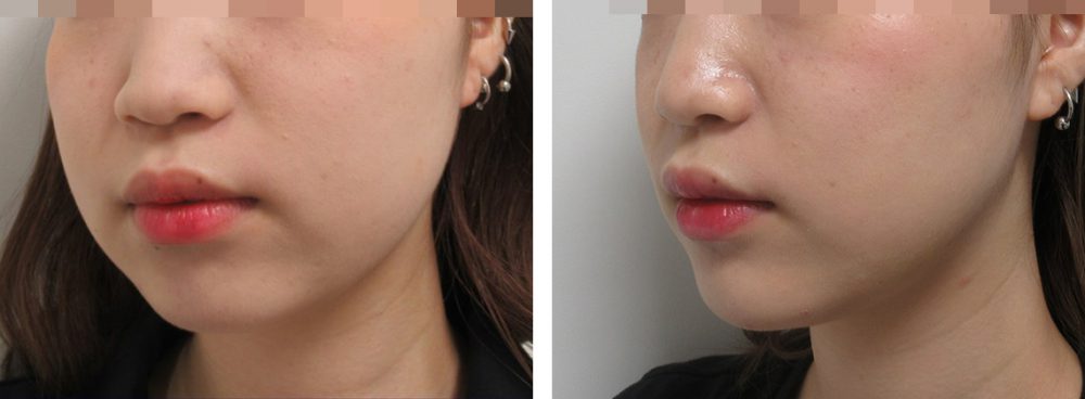 TAC式 ツヤ肌コラーゲンリフト®/バッカルファット除去の症例写真 施術前後 バッカルファット除去とリフトアップ1週間