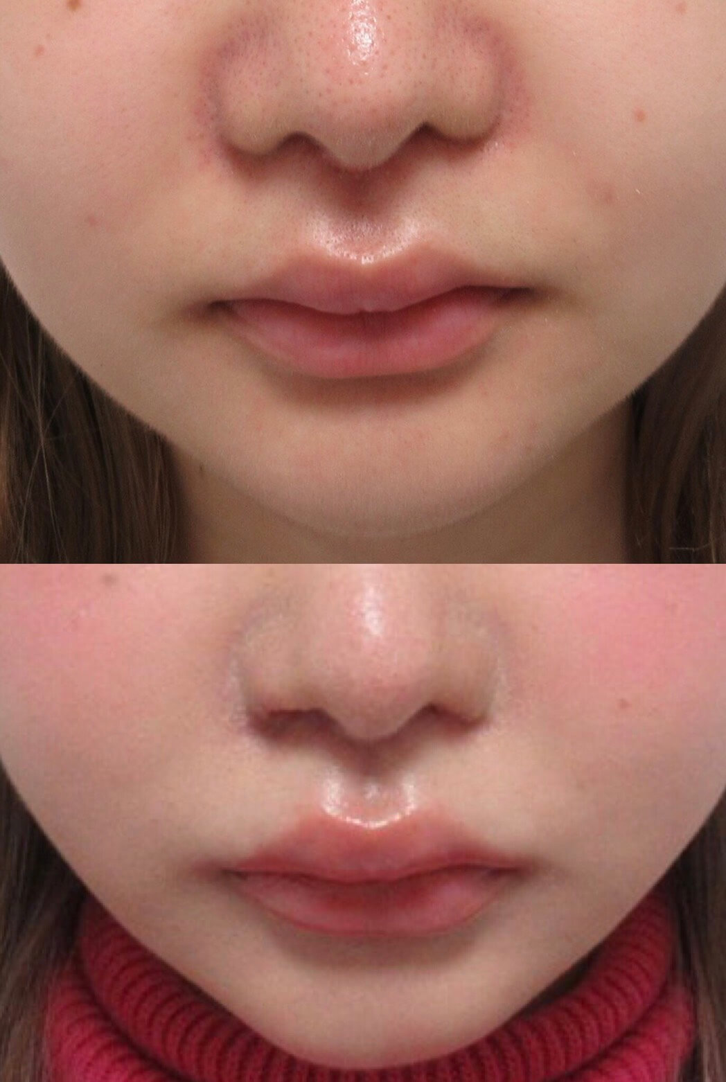 鼻孔縁挙上術について 肉厚なお鼻 垂れた小鼻の改善 Taクリニック公式整形ブログ 画像 値段 美容整形 美容外科