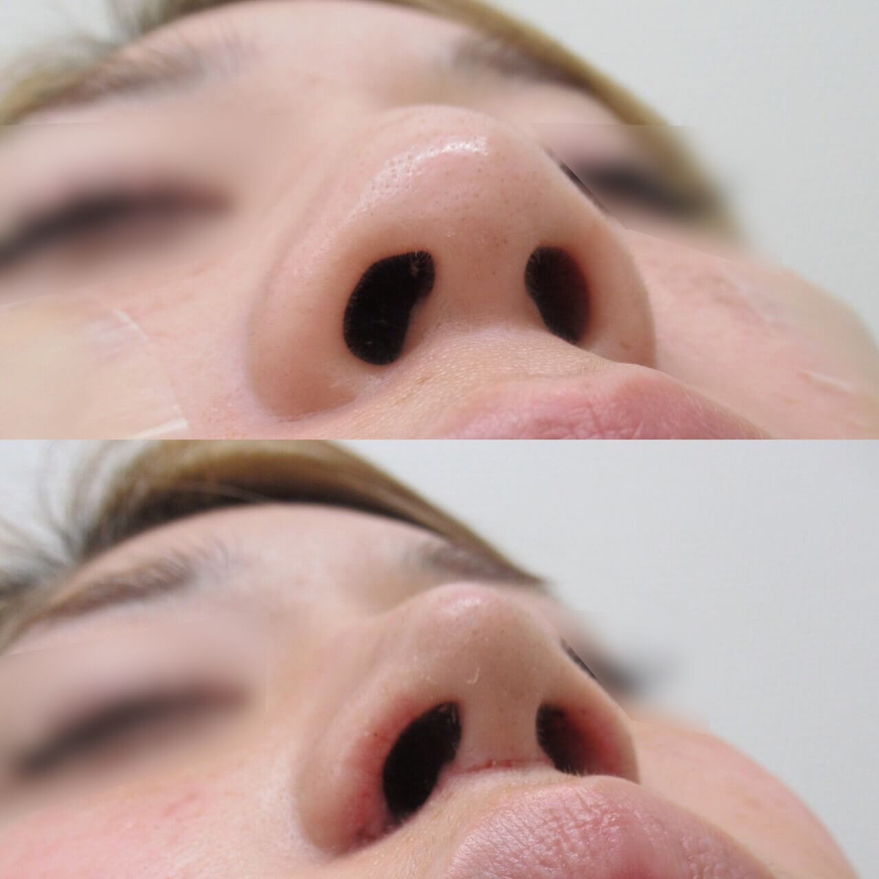 【公式】糸による鼻整形|Nビューティ銀座クリニック