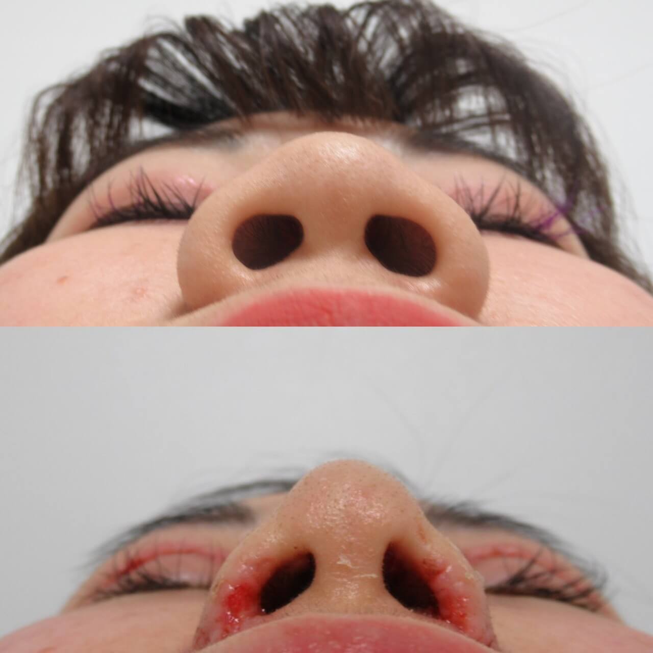 お鼻のフルカスタマイズ一週間経過 Taクリニック公式整形ブログ 画像 値段 美容整形 美容外科