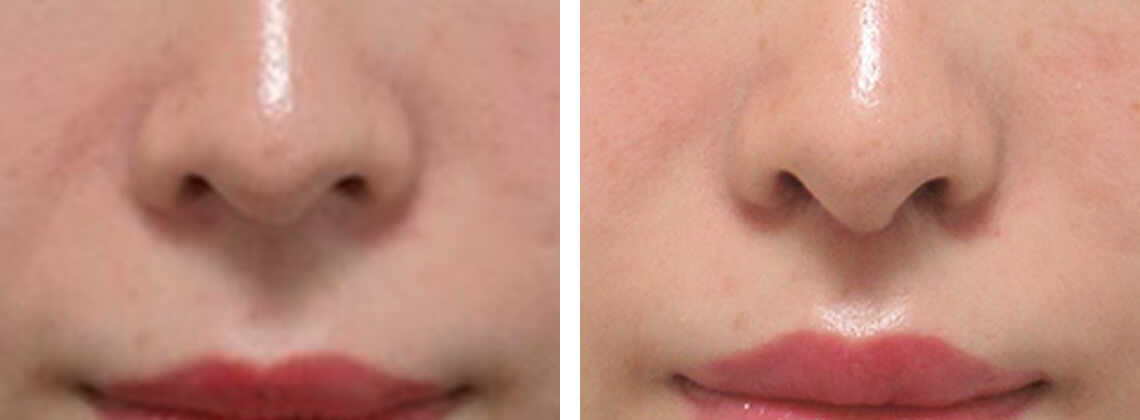 人中を少し短くするだけで