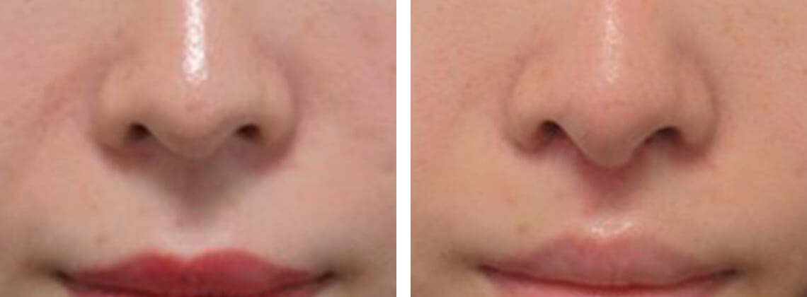 人中短縮術(リップリフト)・外側人中短縮術の症例写真 施術前後 １週間