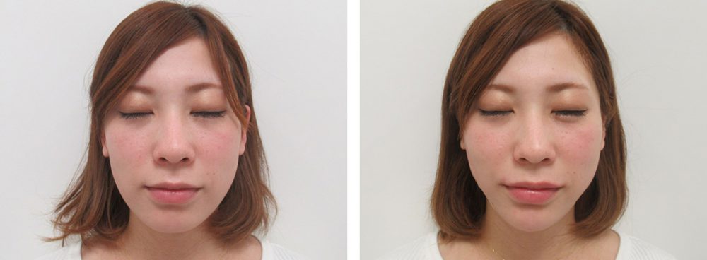 TAC式 ツヤ肌コラーゲンリフト®/ヒアルロン酸注射：その他の症例写真 施術前後 直後