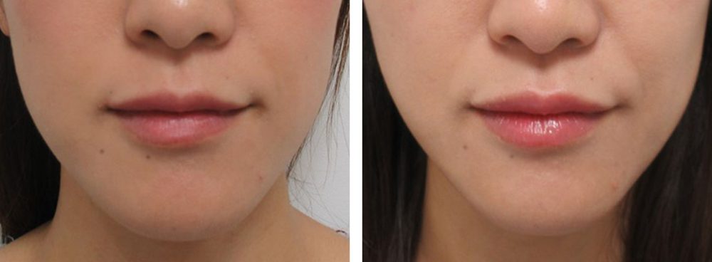 リフトアップで面長を小顔にしたい