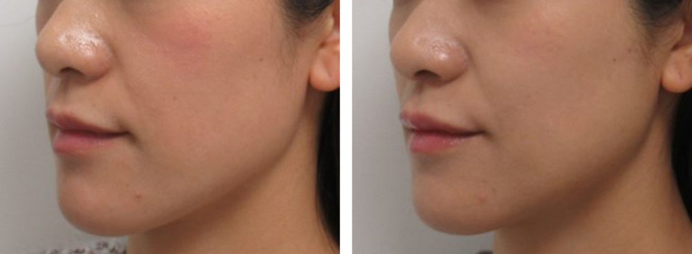 TAC式 ツヤ肌コラーゲンリフト®/ヒアルロン酸注射：その他/ボトックス注射：その他の症例写真 施術前後 １週間