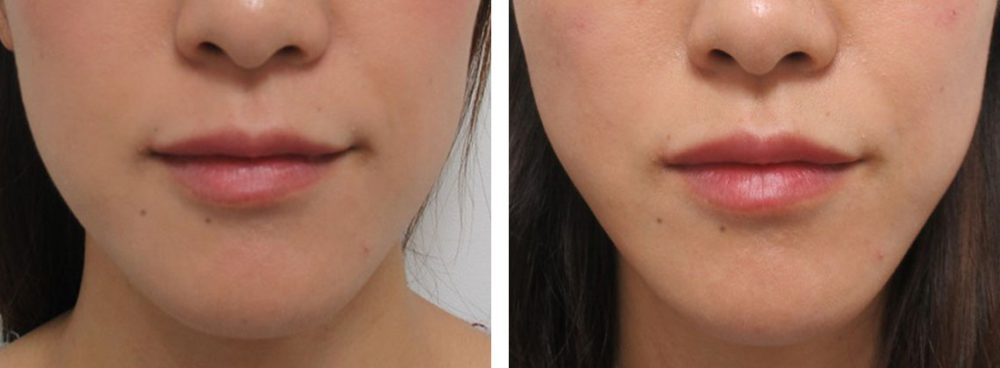 TAC式 ツヤ肌コラーゲンリフト®/ヒアルロン酸注射：その他/ボトックス注射：その他の症例写真 施術前後 直後