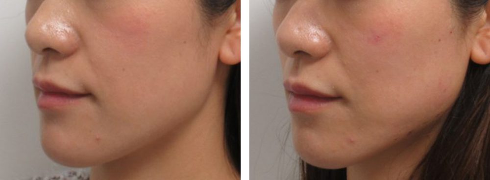 TAC式 ツヤ肌コラーゲンリフト®/ヒアルロン酸注射：その他/ボトックス注射：その他の症例写真 施術前後 直後