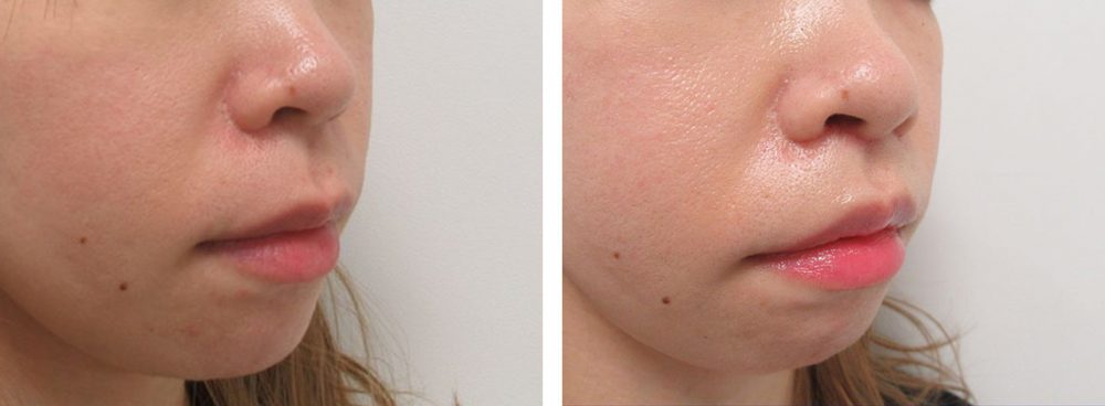 人中短縮術(リップリフト)・外側人中短縮術の症例写真 施術前後 １週間