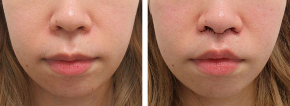 人中短縮術(リップリフト)・外側人中短縮術の症例写真 施術前後 直後