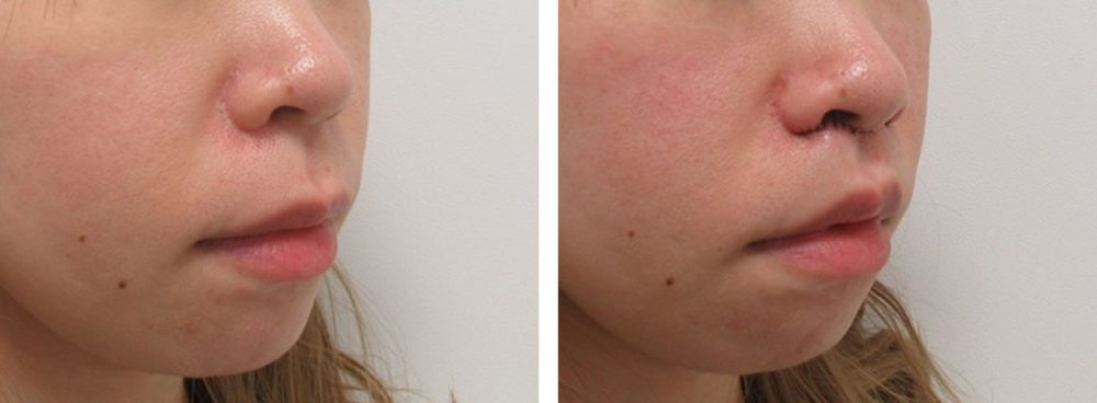 人中短縮術(リップリフト)・外側人中短縮術の症例写真 施術前後 直後