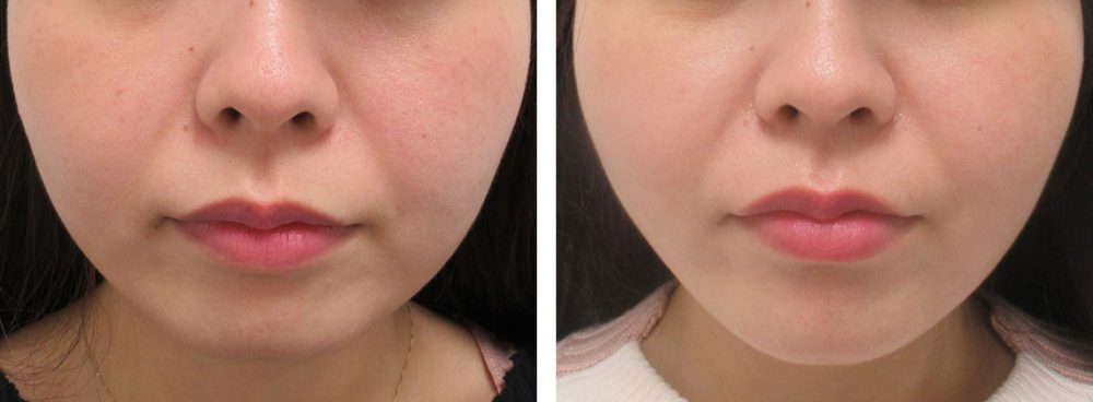 リフトアップとEライン