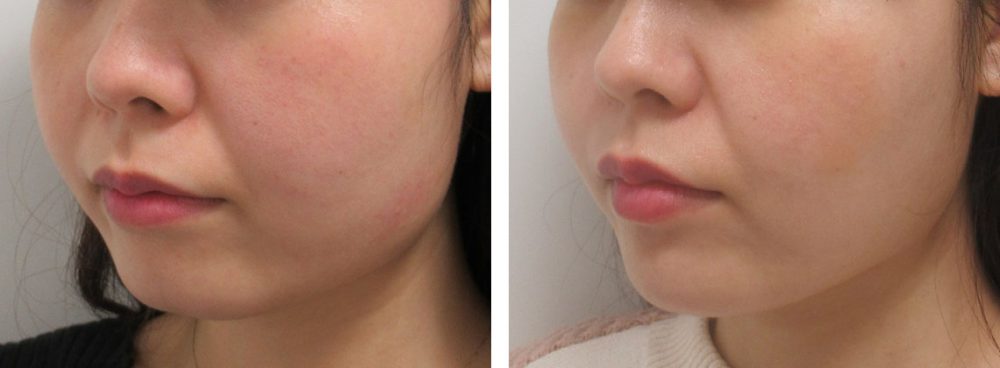 TAC式 ツヤ肌コラーゲンリフト®/ヒアルロン酸注射：その他の症例写真 施術前後 ３週間