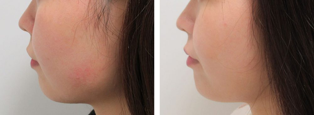 TAC式 ツヤ肌コラーゲンリフト®/ヒアルロン酸注射：その他の症例写真 施術前後 ３週間