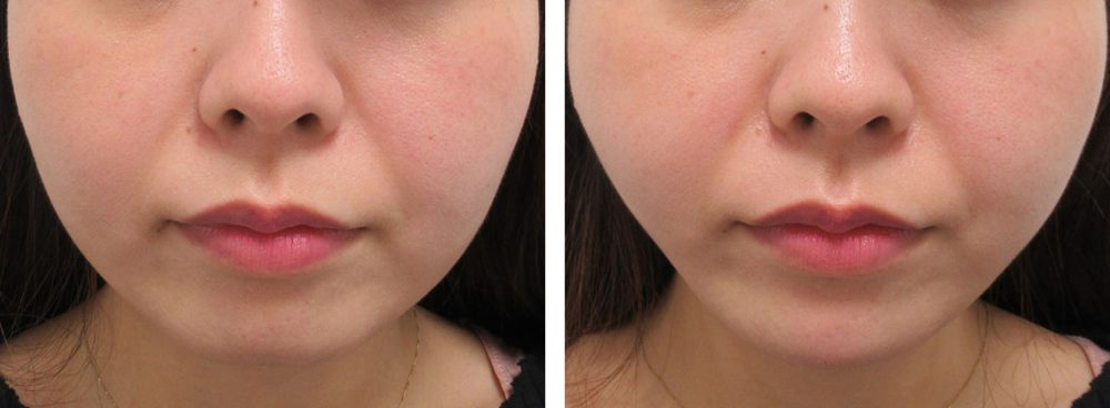 TAC式 ツヤ肌コラーゲンリフト®/ヒアルロン酸注射：その他の症例写真 施術前後 直後