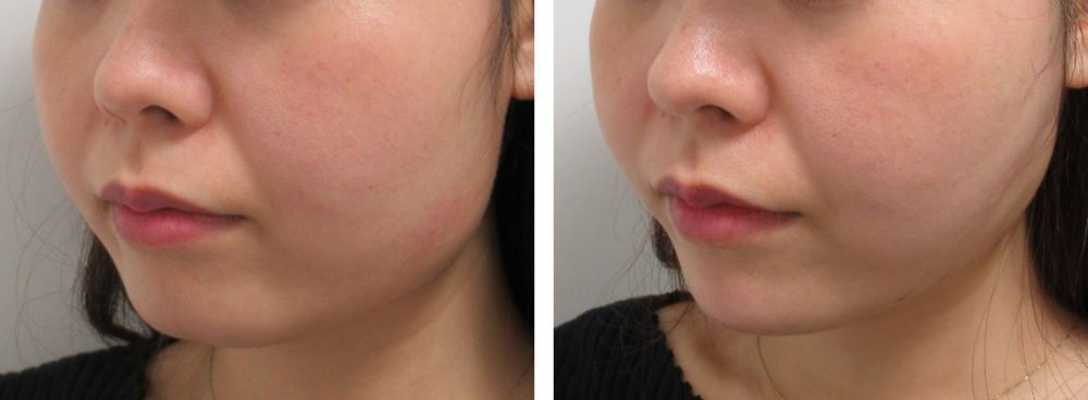 TAC式 ツヤ肌コラーゲンリフト®/ヒアルロン酸注射：その他の症例写真 施術前後 直後