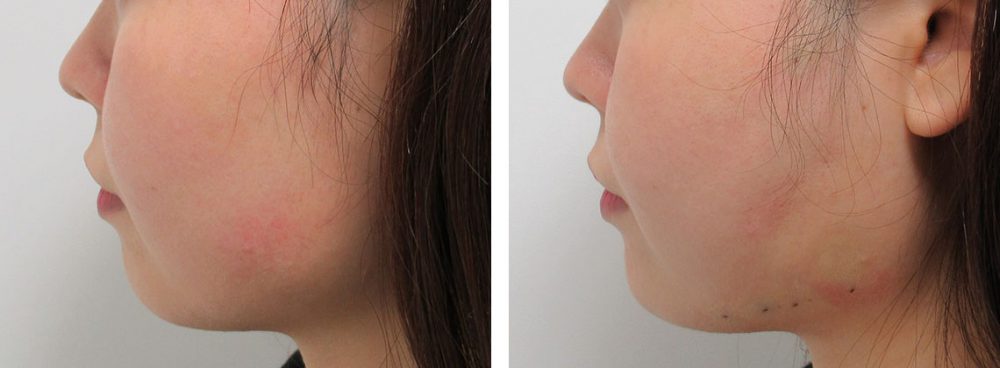 TAC式 ツヤ肌コラーゲンリフト®/ヒアルロン酸注射：その他の症例写真 施術前後 直後