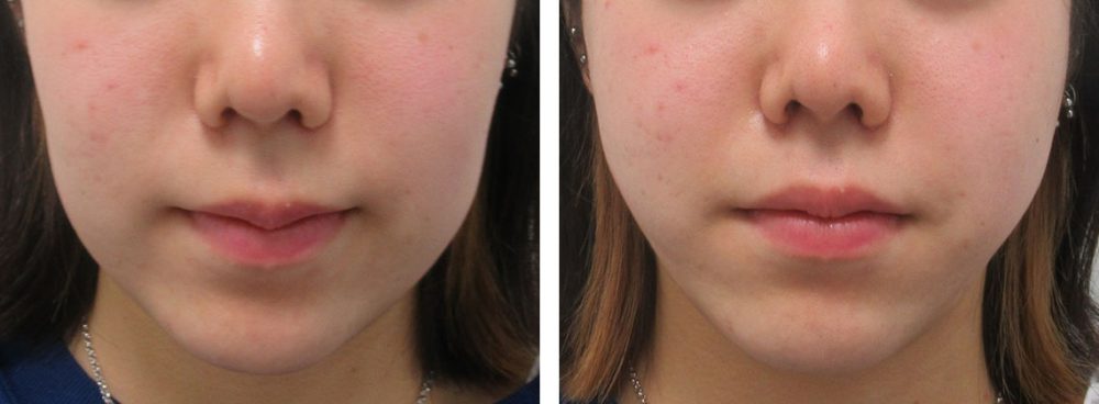 TAC式 ツヤ肌コラーゲンリフト®/ボトックス注射：その他の症例写真 施術前後 直後