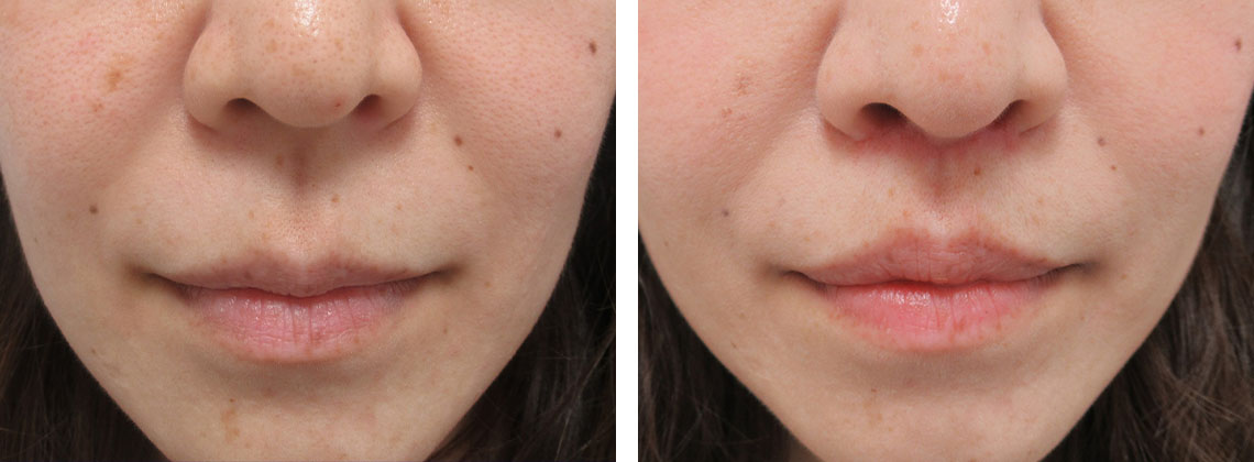 人中短縮術(リップリフト)・外側人中短縮術の症例写真 施術前後 １ヵ月