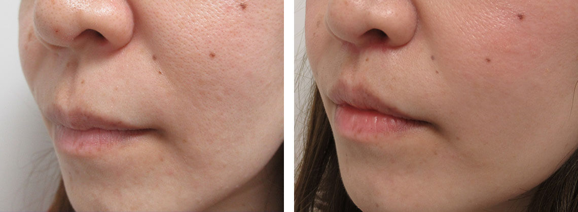 人中短縮術(リップリフト)・外側人中短縮術の症例写真 施術前後 １ヵ月