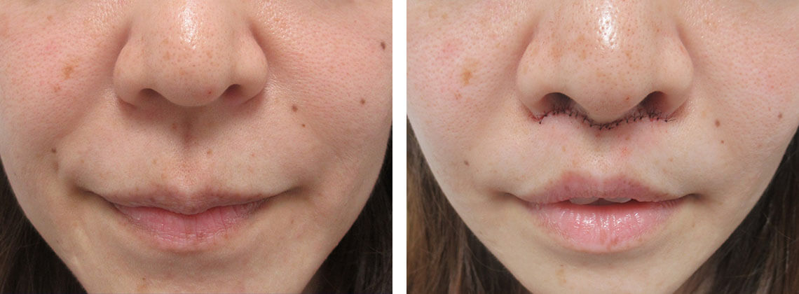 人中短縮術(リップリフト)・外側人中短縮術の症例写真 施術前後 直後
