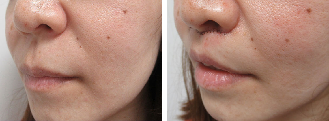 人中短縮術(リップリフト)・外側人中短縮術の症例写真 施術前後 直後