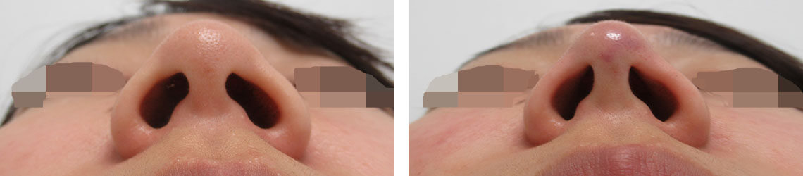 鼻尖形成・鼻尖縮小の症例写真 施術前後 直後