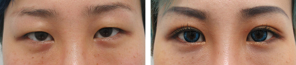 結膜側埋没法、特殊埋没六点留にて埋没