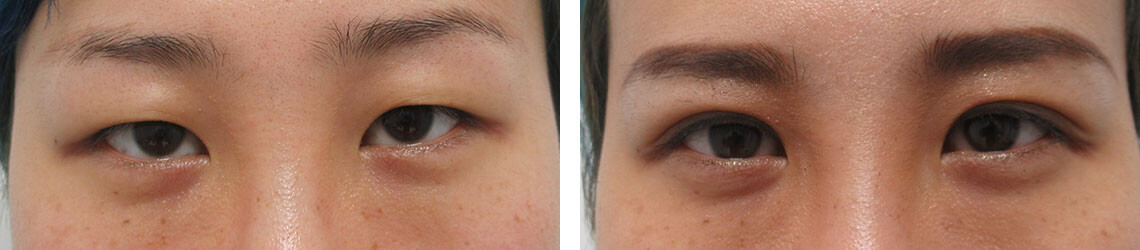 二重埋没法の症例写真 施術前後 ２週間