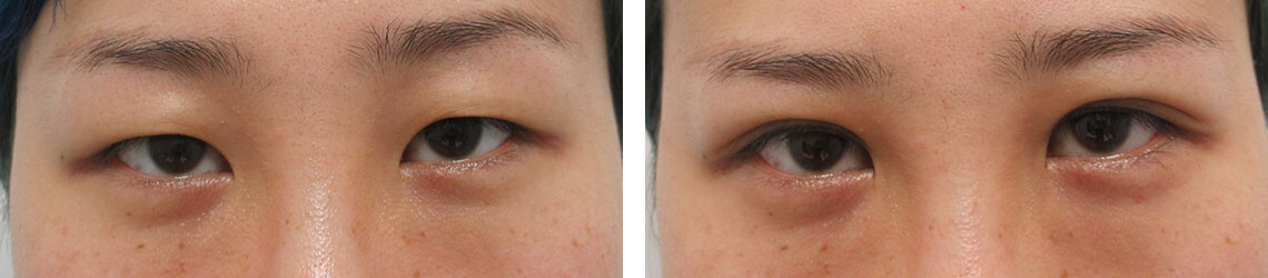 二重埋没法の症例写真 施術前後 直後