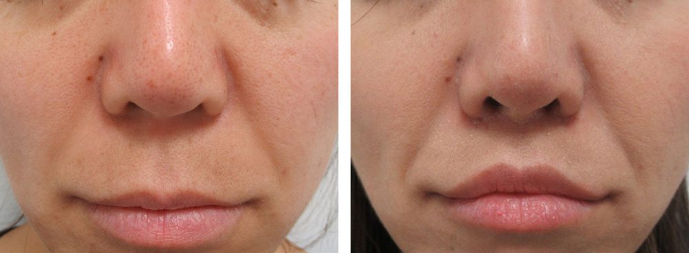 人中短縮術とアヒル口形成