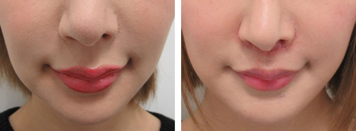 人中短縮術(リップリフト)・外側人中短縮術の症例写真 施術前後 １週間