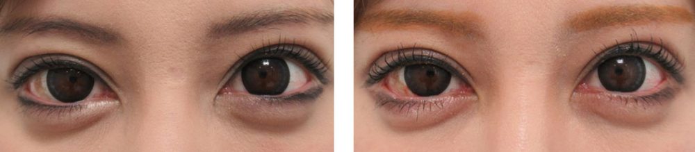 切らないタレ目手術