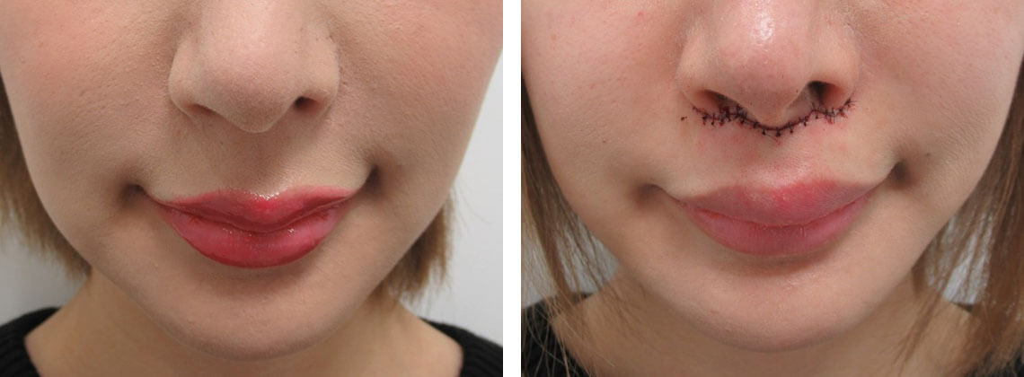 人中短縮術(リップリフト)・外側人中短縮術の症例写真 施術前後 直後