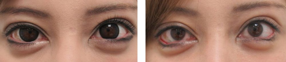 グラマラスライン（タレ目形成）の症例写真 施術前後 直後