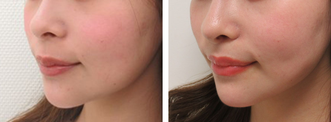 伸びてしまった人中を短くする