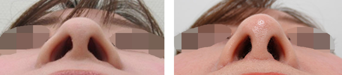 TAC式 ツヤ肌コラーゲンリフト®/人中短縮術(リップリフト)・外側人中短縮術の症例写真 施術前後 １ヵ月