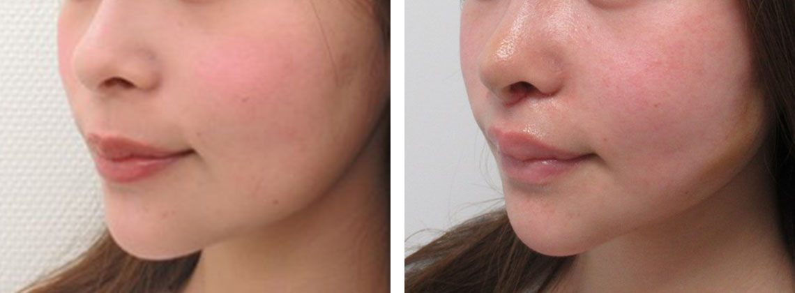 TAC式 ツヤ肌コラーゲンリフト®/人中短縮術(リップリフト)・外側人中短縮術の症例写真 施術前後 １週間