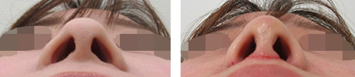 TAC式 ツヤ肌コラーゲンリフト®/人中短縮術(リップリフト)・外側人中短縮術の症例写真 施術前後 １週間