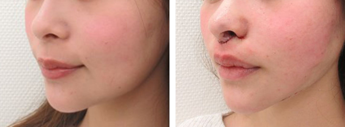 TAC式 ツヤ肌コラーゲンリフト®/人中短縮術(リップリフト)・外側人中短縮術の症例写真 施術前後 直後