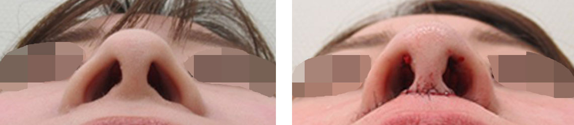 TAC式 ツヤ肌コラーゲンリフト®/人中短縮術(リップリフト)・外側人中短縮術の症例写真 施術前後 直後