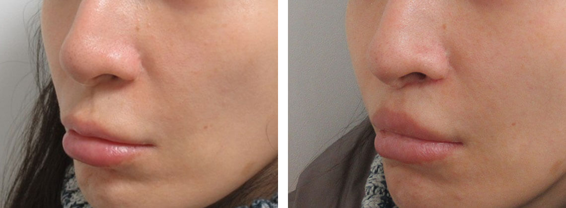 人中短縮術で口角まで引き上げる場合