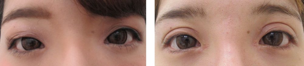 目頭切開術/グラマラスライン（タレ目形成）/二重切開（全切開法）の症例写真 施術前後 １ヵ月と３週間