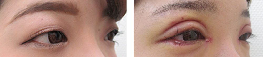 目頭切開術/グラマラスライン（タレ目形成）/二重切開（全切開法）の症例写真 施術前後 １ヵ月と２日