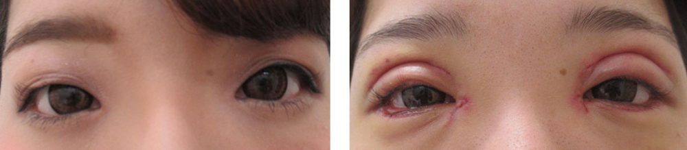 目頭切開術/グラマラスライン（タレ目形成）/二重切開（全切開法）の症例写真 施術前後 １ヵ月と２日
