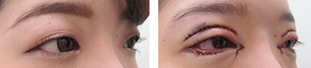 目頭切開術/グラマラスライン（タレ目形成）/二重切開（全切開法）の症例写真 施術前後 直後