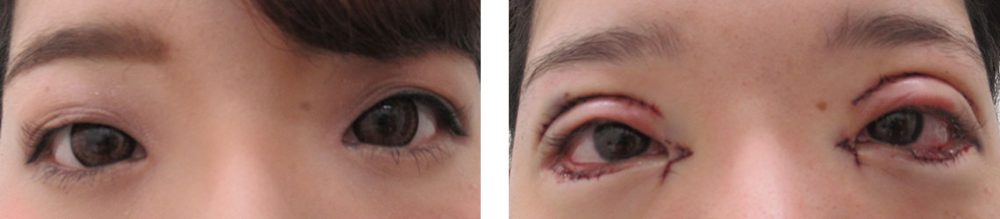 目頭切開術/グラマラスライン（タレ目形成）/二重切開（全切開法）の症例写真 施術前後 直後