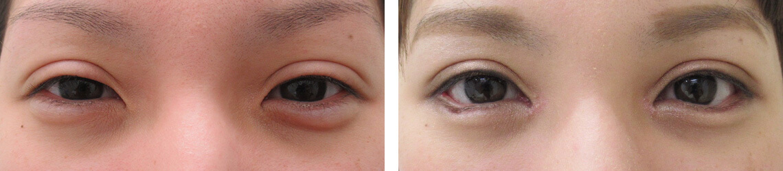 目尻切開術/目頭切開術/グラマラスライン（タレ目形成）の症例写真 施術前後 １ヵ月