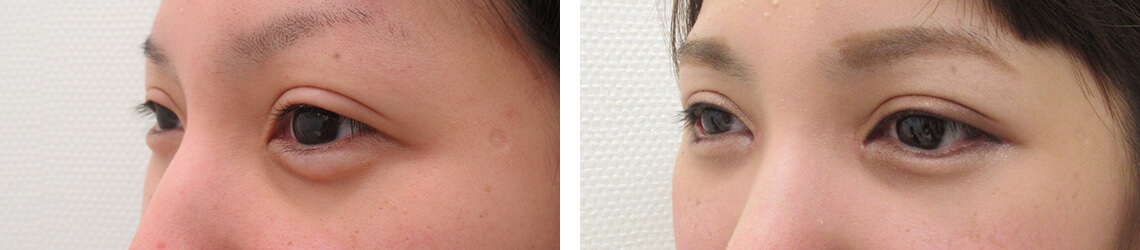 目尻切開術/目頭切開術/グラマラスライン（タレ目形成）の症例写真 施術前後 １ヵ月